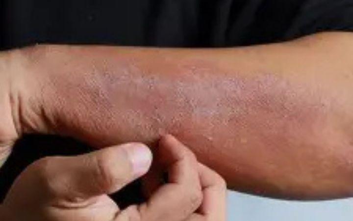 Hospital Moinhos de Vento oferece atendimento especializado para pacientes com dermatite atópica